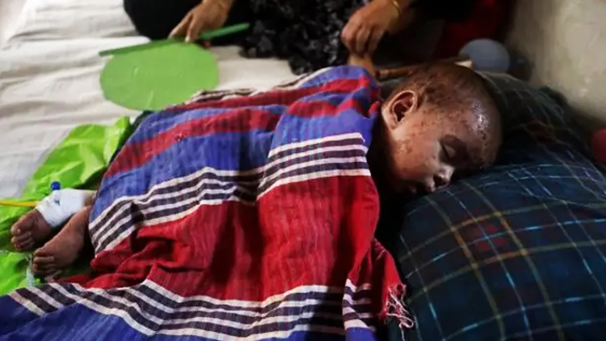 একদিনে হাম উপসর্গে আরও ৮ জনের মৃত্যু